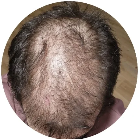 Customer photo: top of a man's head showing thinning hair on the crown
